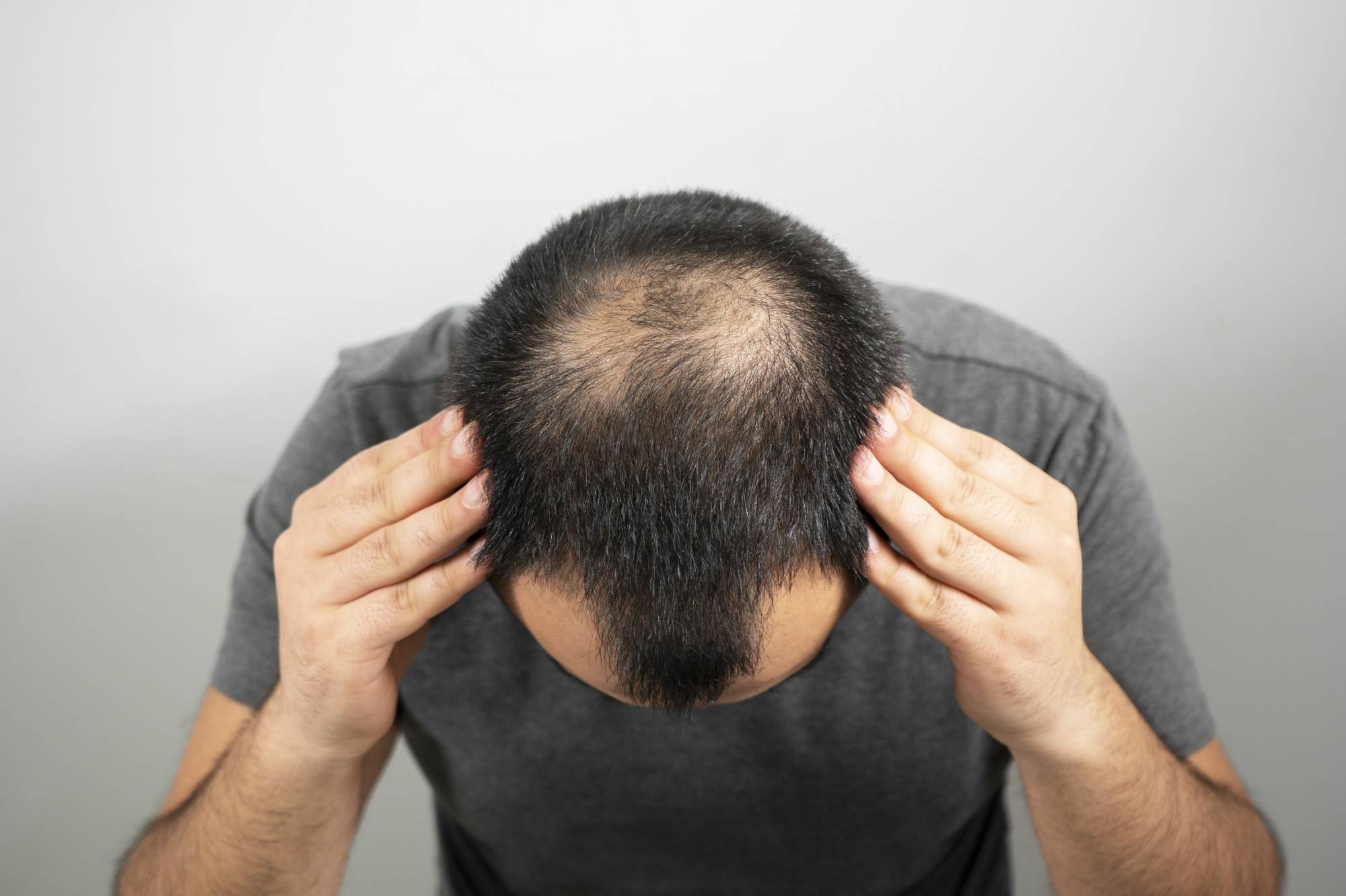 Treatment For Alopecia