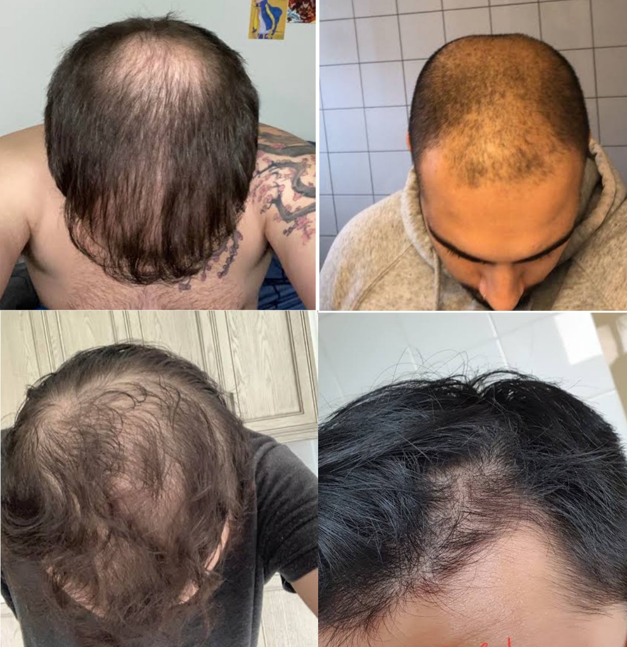 Finasteride Shedding Why It Happens And What It Means Pictures Meds 