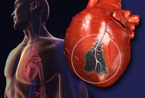 Polypill For Heart Patients