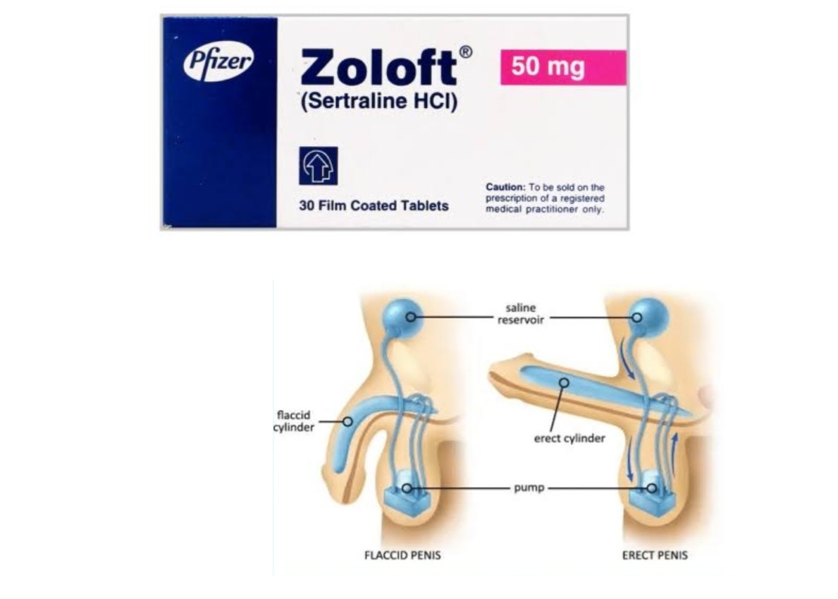 zoloft erectile dysfunction permanent