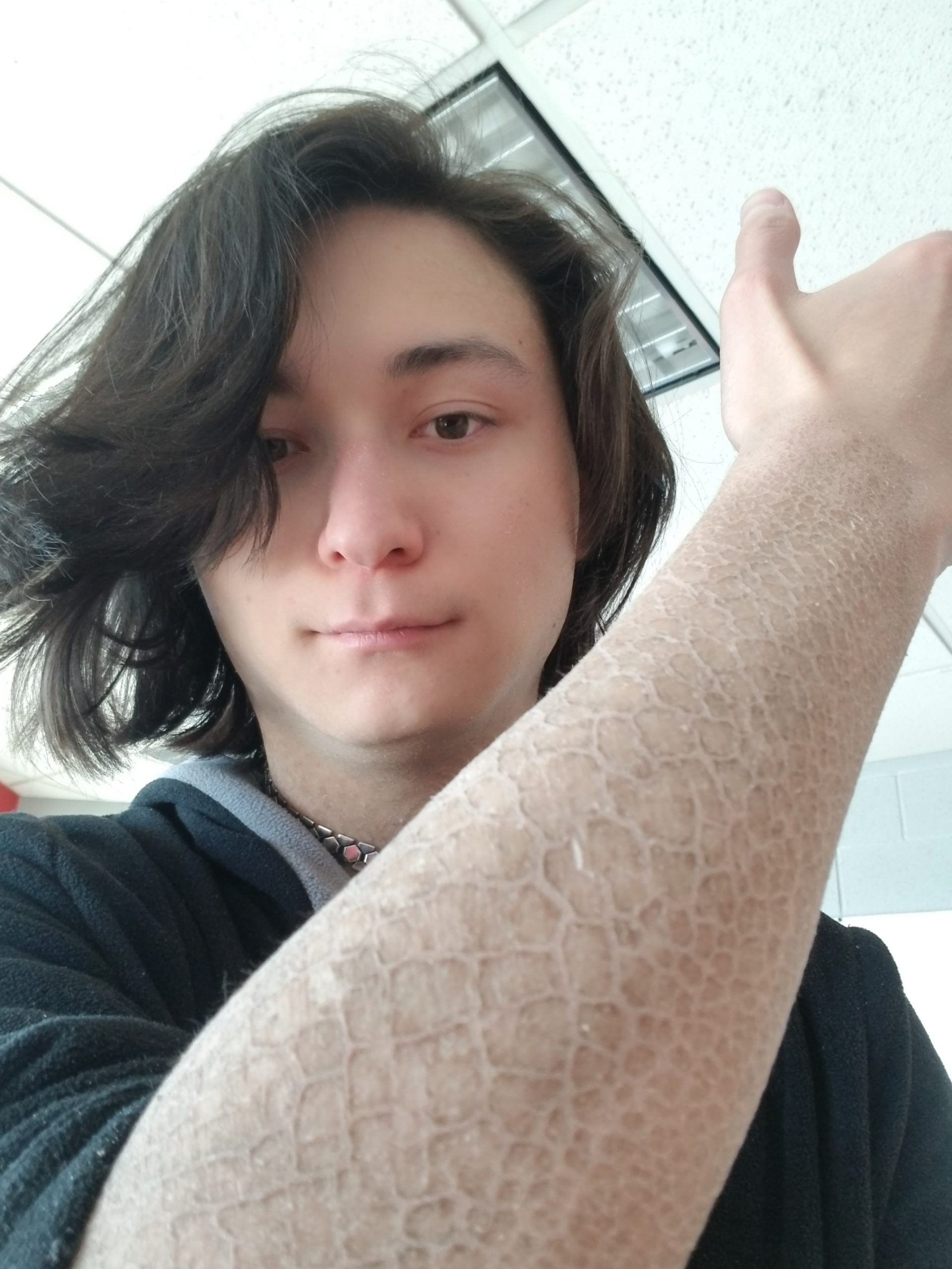 Drugs That Causes Alligator Skin scaled