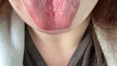 Medications That Cause Burning Mouth Syndrome scaled