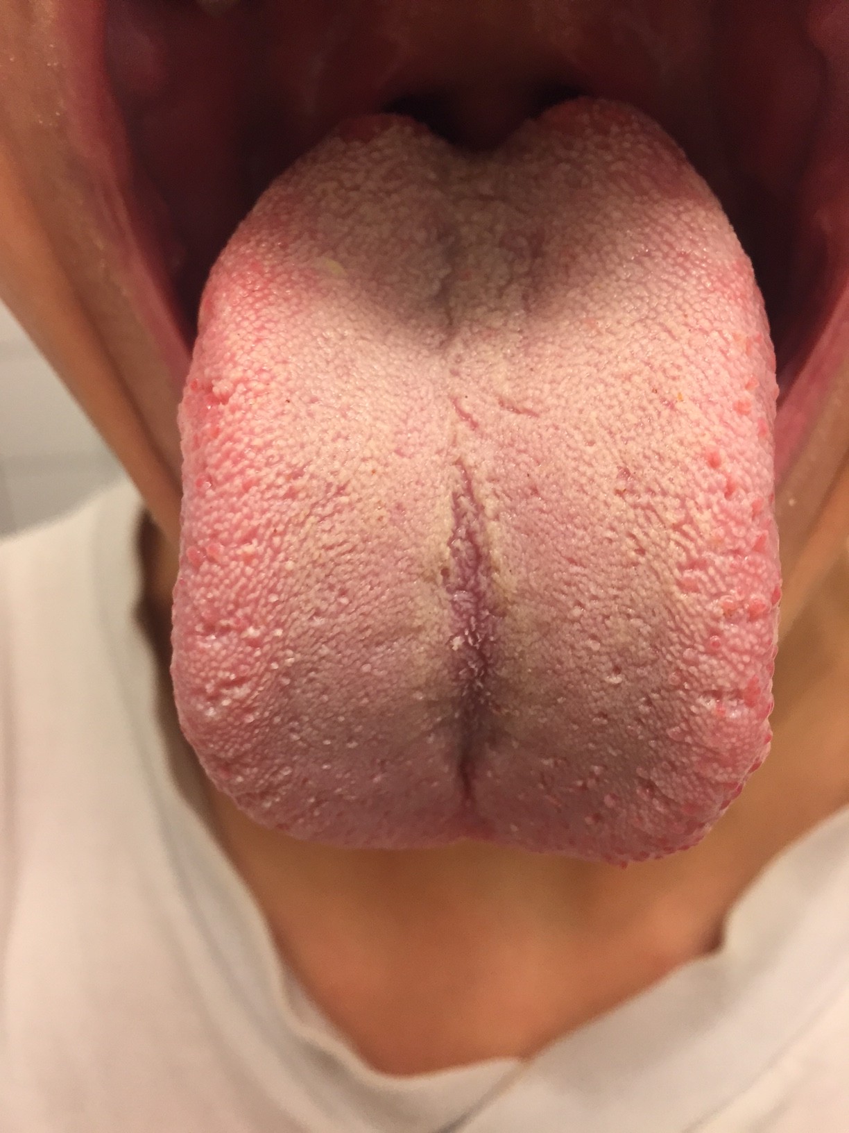 Medications That Cause Dry Mouth