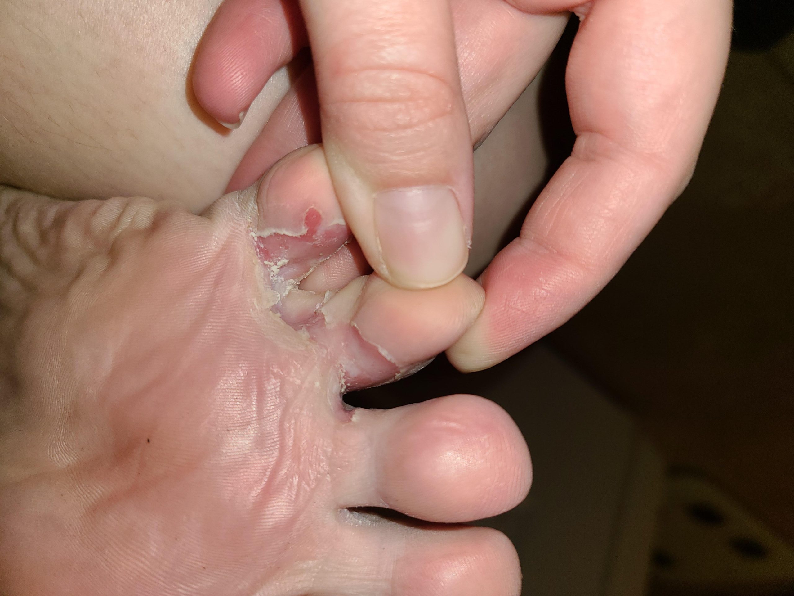 Athletes Foot Creams