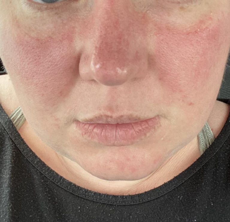 DrugInduced Lupus List Of Medications Meds Safety