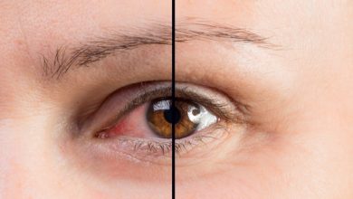 Sertraline Eye Side Effects