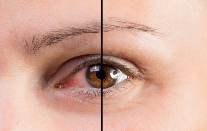 Sertraline Eye Side Effects