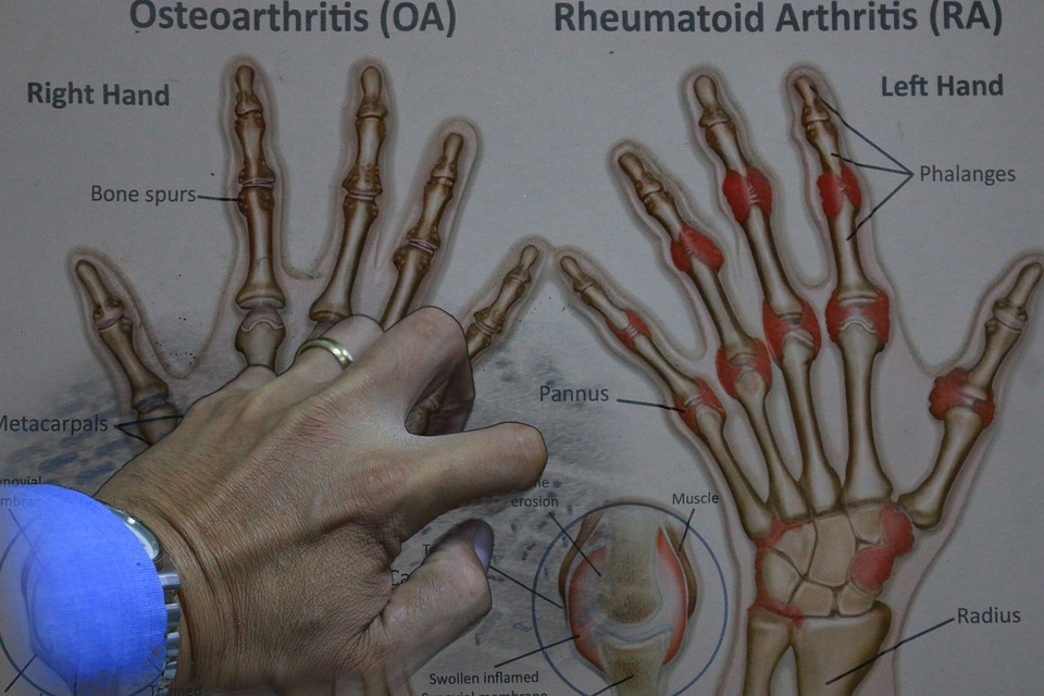 What Is The Safest Drug For Rheumatoid Arthritis