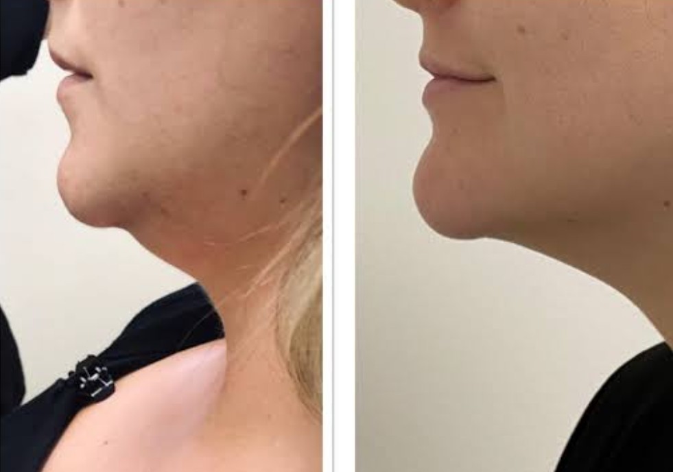 1 month lipotropic injections results