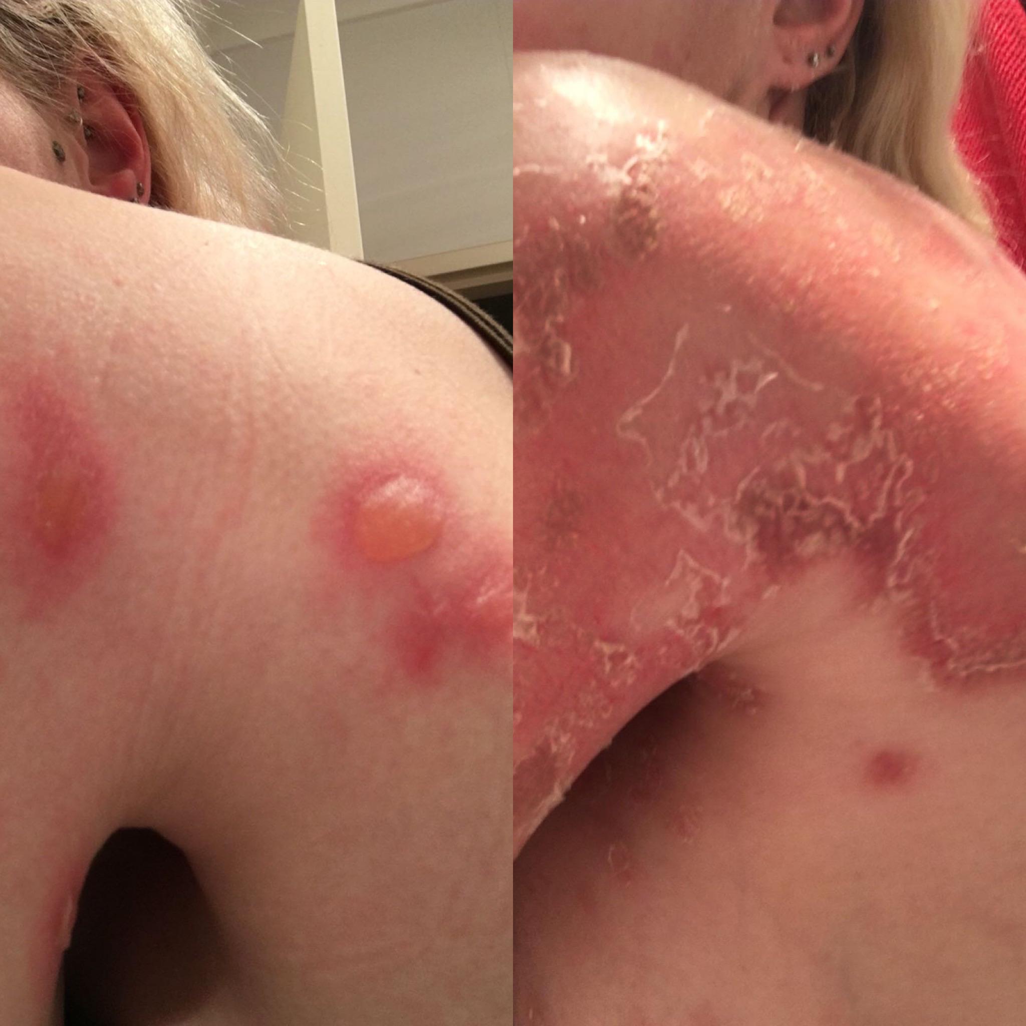 Difference Between Sjs And Ten