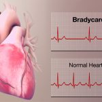 Drugs That Cause Bradycardia