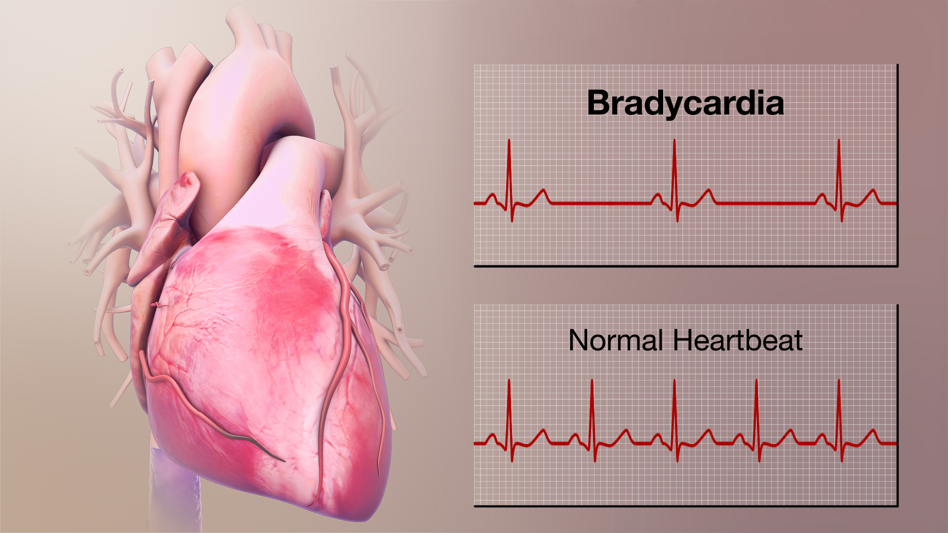 drugs-that-cause-bradycardia-meds-safety