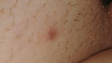 bumps on vaginal area