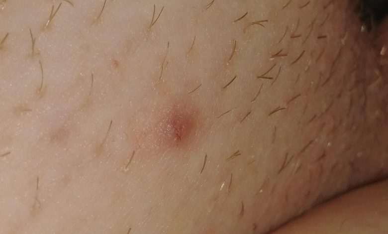 bumps on vaginal area