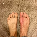 How To Take Colchicine For Acute Gout