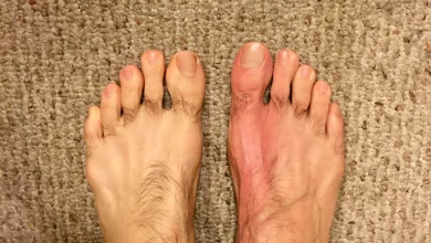 How To Take Colchicine For Acute Gout