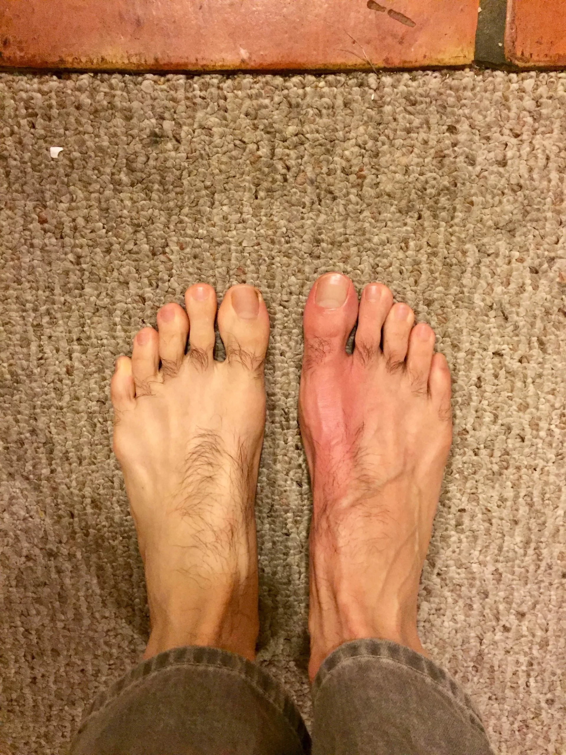 How To Take Colchicine For Acute Gout