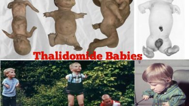 Thalidomide Babies