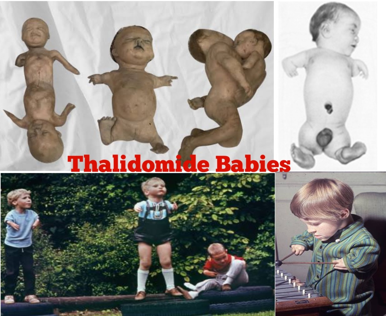 Thalidomide Babies