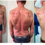 Lack Of Vitamin D Increases The Severity of Psoriasis Symptoms