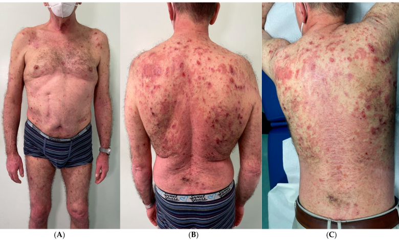 Lack Of Vitamin D Increases The Severity of Psoriasis Symptoms