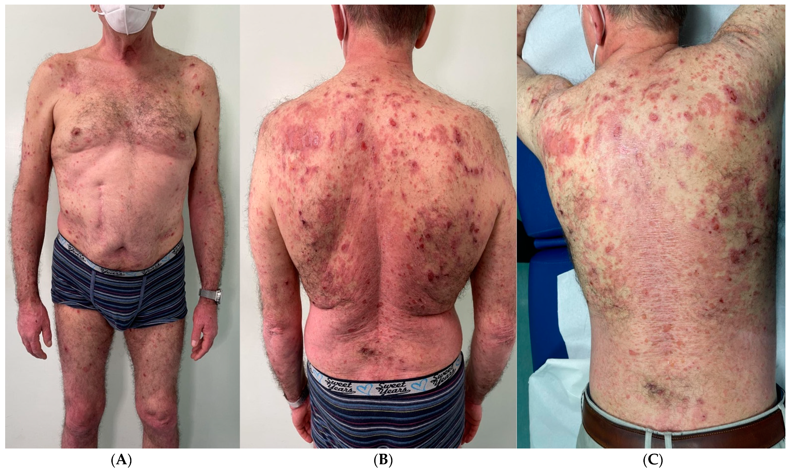 Lack Of Vitamin D Increases The Severity of Psoriasis Symptoms