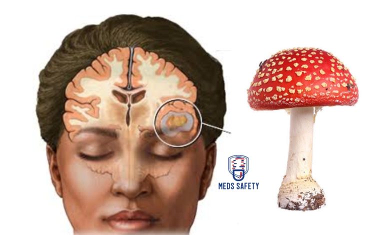 How Psilocybin in Magic Mushroom Help With Migraines
