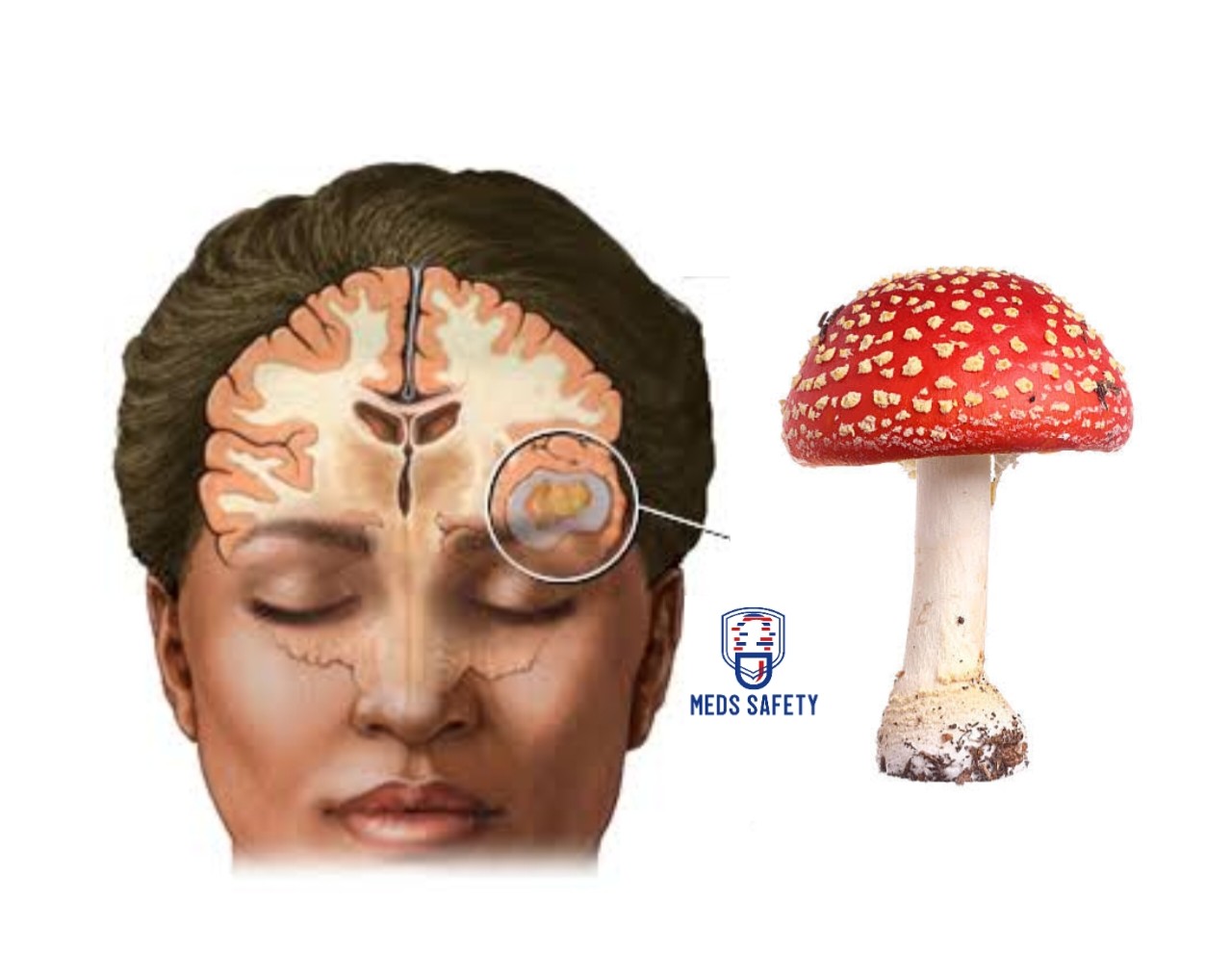 How Psilocybin in Magic Mushroom Help With Migraines