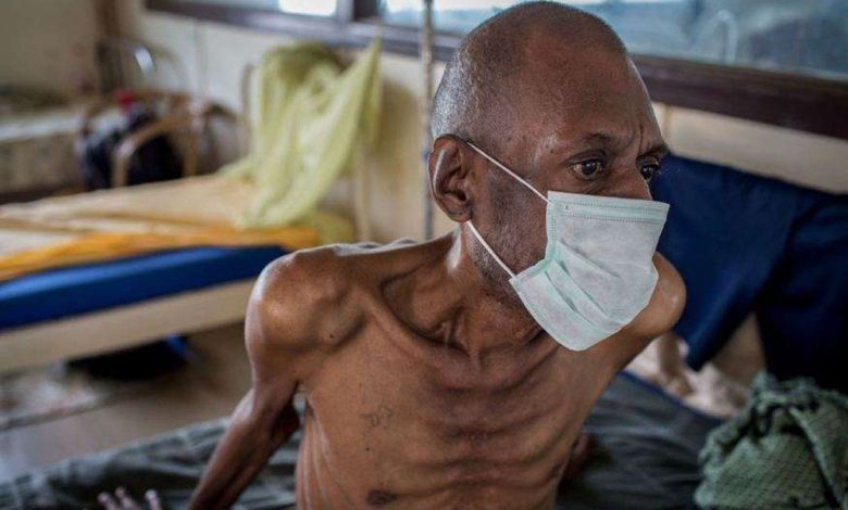 Johnson & Johnson Slashes Price of TB Drug in Low Income Countries to Expand Access