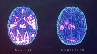 How Antidepressant Response is Measured