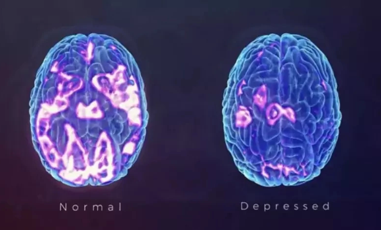 How Antidepressant Response is Measured