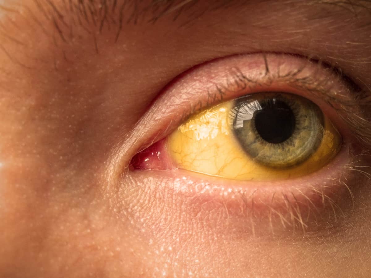 can drugs cause jaundice