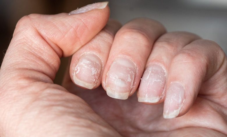 Drugs That Can Affect The Appearance Of Your Finger and Toe Nails