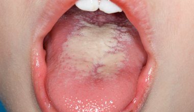 Can Antibiotics Cause Mouth Thrush