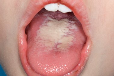 Can Antibiotics Cause Mouth Thrush