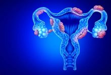 Israel's Gynica starts clinical trial for endometriosis cure