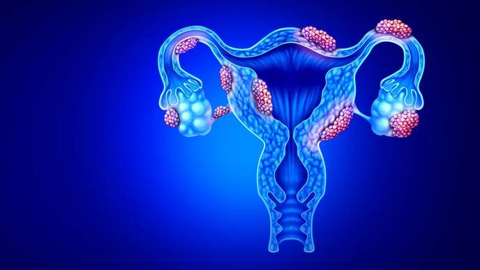 Israel's Gynica starts clinical trial for endometriosis cure